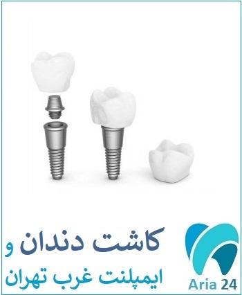 کاشت دندان و ایمپلنت غرب تهران دکتر سید محسنی فوق تخصص ایمپلنت